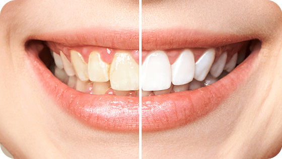 Dentes brancos com um procedimento rápido e com efeito instantâneo na sua aparência!